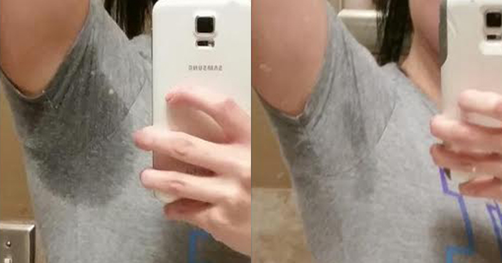 MiraDry-B&A MiraDry-B&A