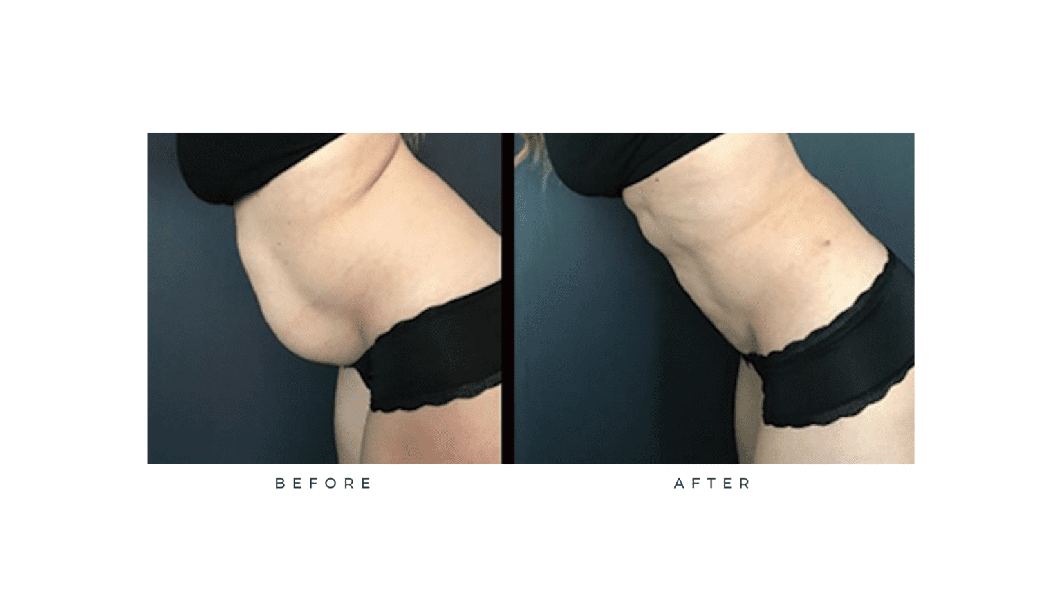 Liposuction Renuvion Tuscan Sun Spa And Salon