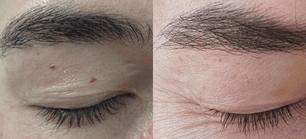 TUS_Lamprobe-Before-After-1