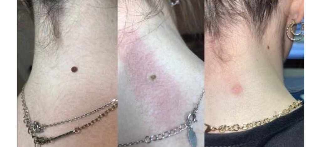 TUS_Lamprobe-Before-After-2